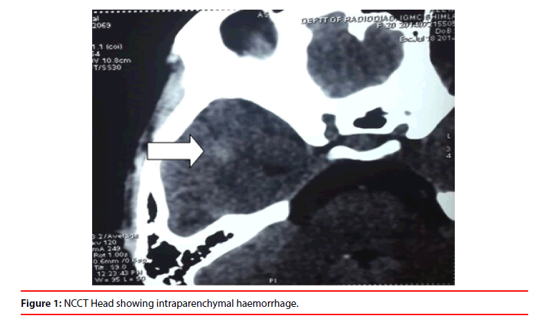 clinical-skills-intraparenchymal-haemorrhage