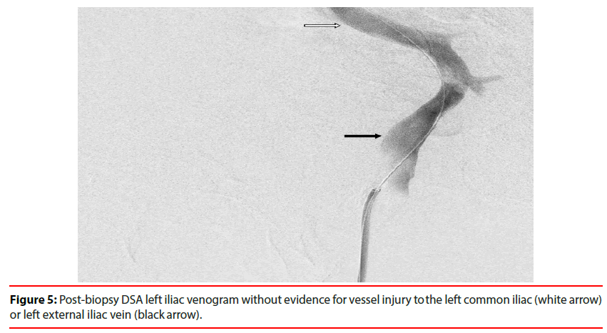 ijocs-Post-biopsy