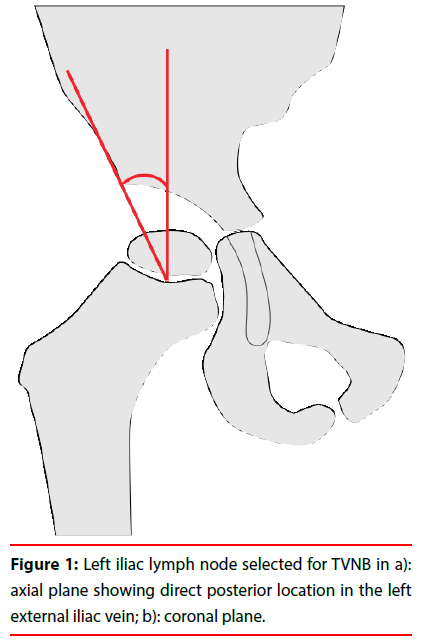 ijocs-lymph-node