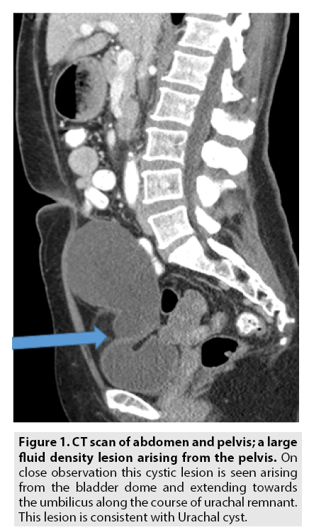 Urachal Cyst Presenting As A Pelvic Mass