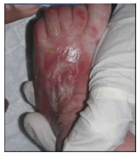 clinical-practice-Granulation