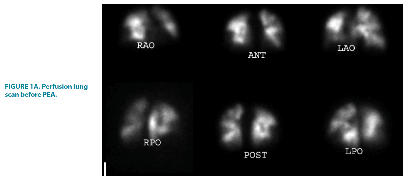 clinical-practice-Perfusion-lung