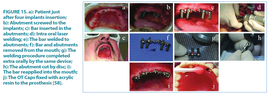 clinical-practice-abutments