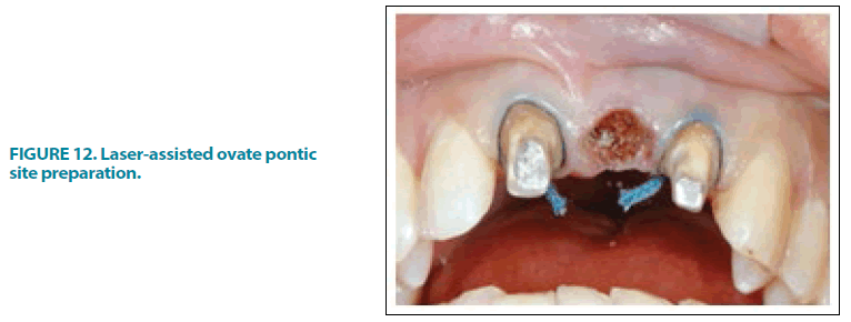 clinical-practice-pontic