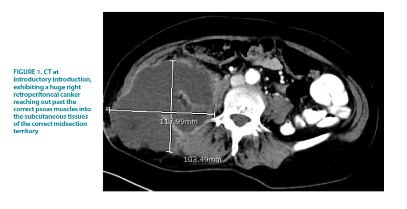 clinical-practice-retroperitoneal-canker