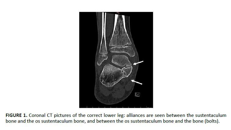 clinical-practice-sustentaculum-bone