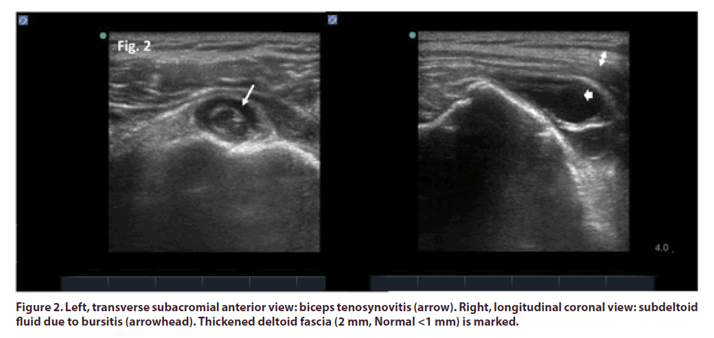 clinical-rheumatology-biceps