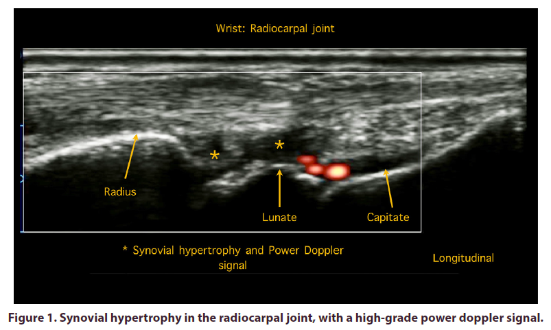 clinical-rheumatology-hypertrophy