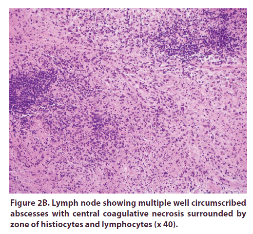 clinical-rheumatology-necrosis