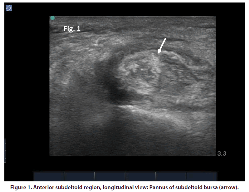 clinical-rheumatology-subdeltoid