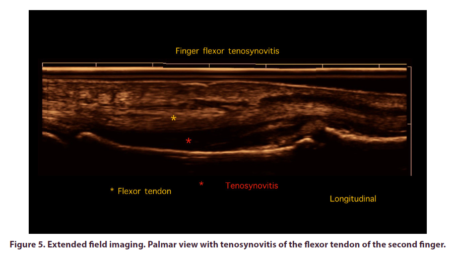 clinical-rheumatology-tenosynovitis