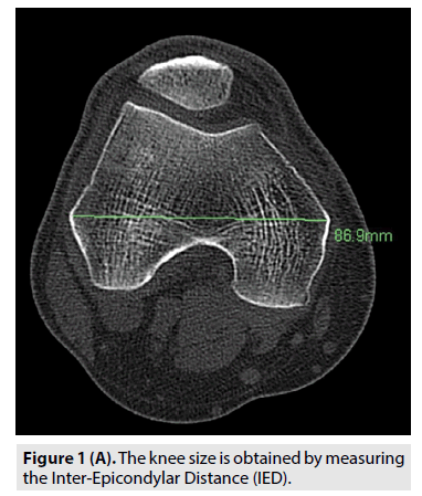 imaging-epicondylar