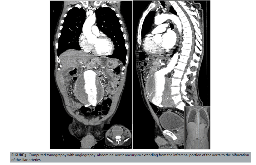 Abdominal aortic aneurysm:Common problem, atypical presentation