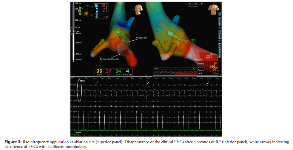 interventional-cardiology-ablation