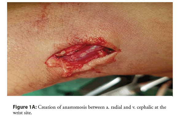 interventional-cardiology-anastomosis