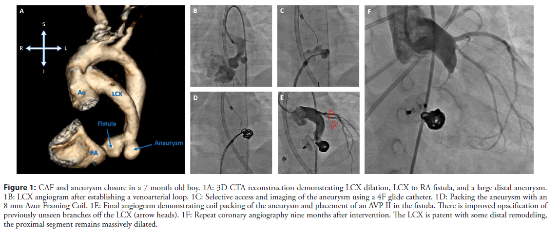 interventional-cardiology-aneurysm