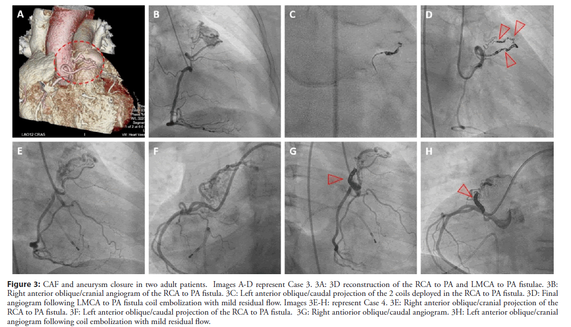 interventional-cardiology-angiogram