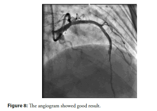 interventional-cardiology-angiogram