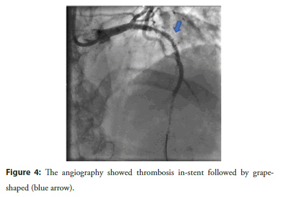 interventional-cardiology-angiography