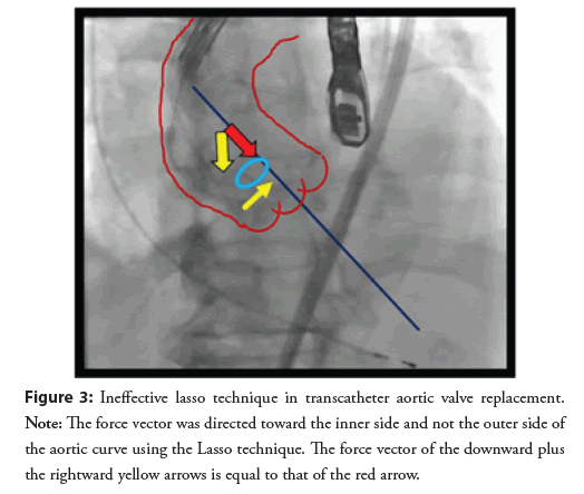 interventional-cardiology-aortic