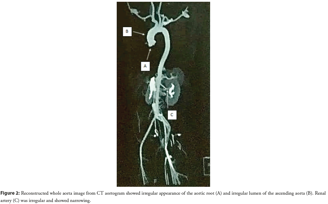 interventional-cardiology-aortogram