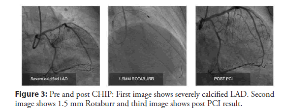 interventional-cardiology-calcified