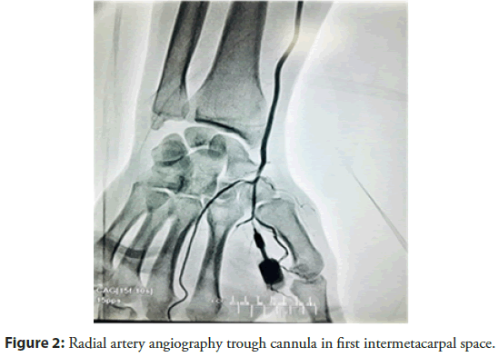 interventional-cardiology-cannula