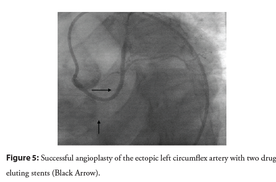 interventional-cardiology-circumflex