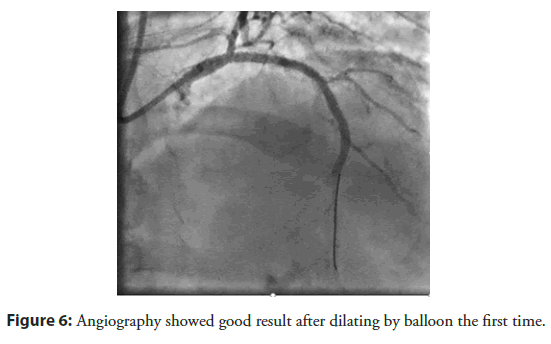 interventional-cardiology-dilating