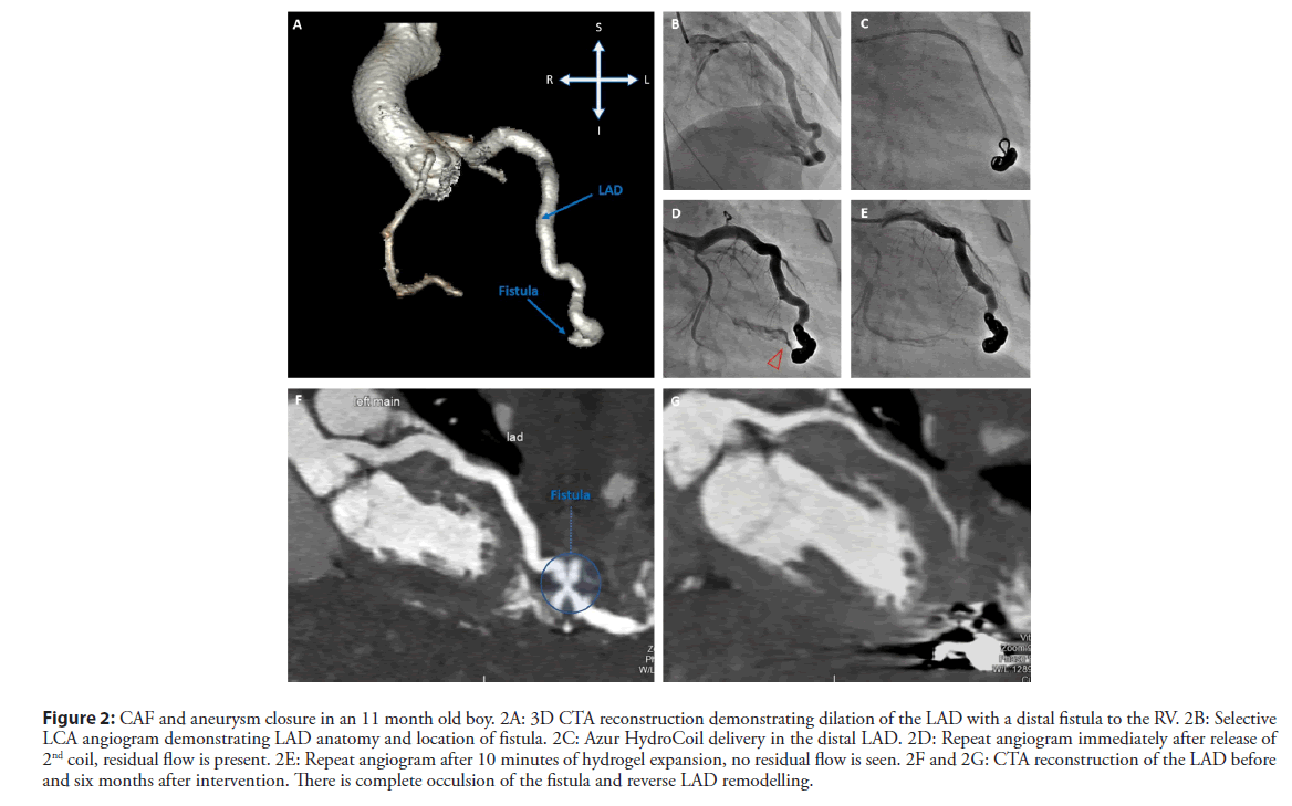 interventional-cardiology-dilation