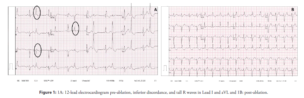 interventional-cardiology-discordance