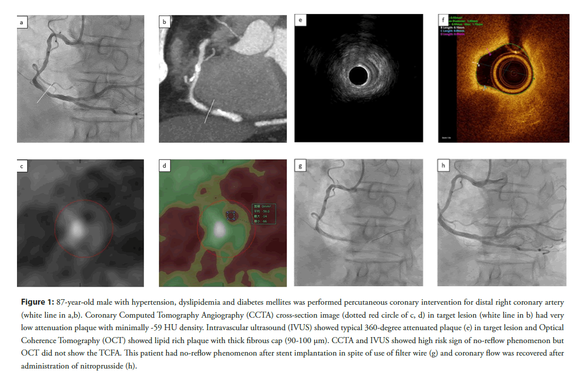 interventional-cardiology-dyslipidemia