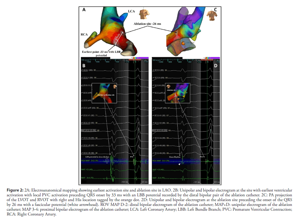 interventional-cardiology-electroanatomical