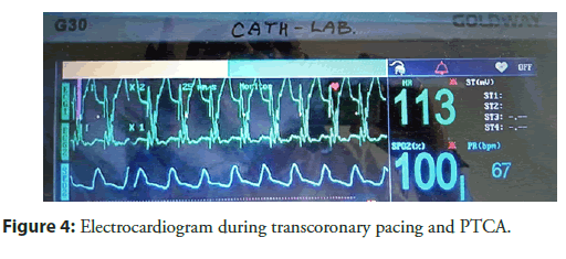 interventional-cardiology-electrocardiogram