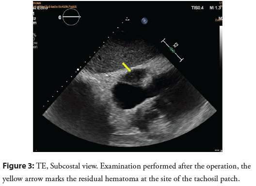 interventional-cardiology-hematoma