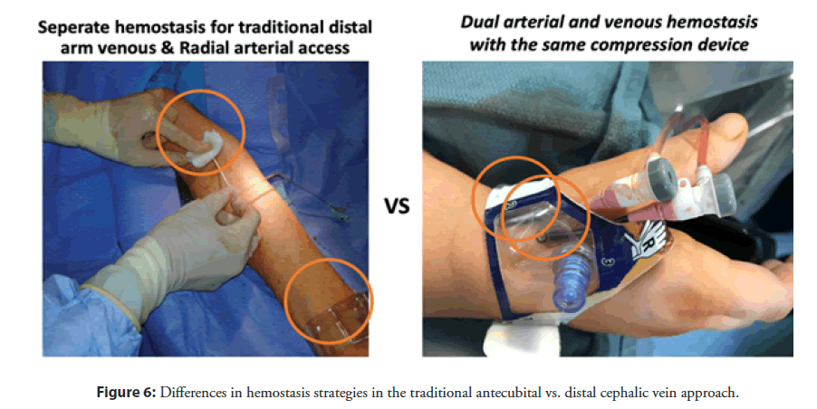 interventional-cardiology-hemostasis
