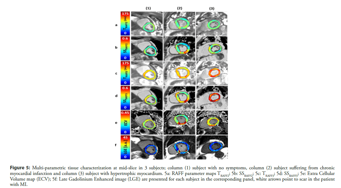 interventional-cardiology-infarction