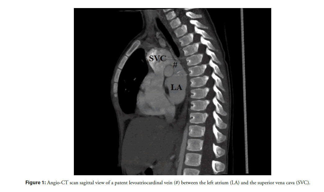 interventional-cardiology-levoatriocardinal