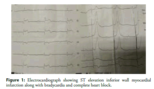 interventional-cardiology-myocardial