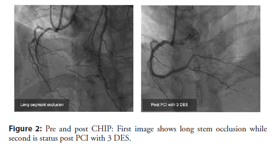 interventional-cardiology-occlusion
