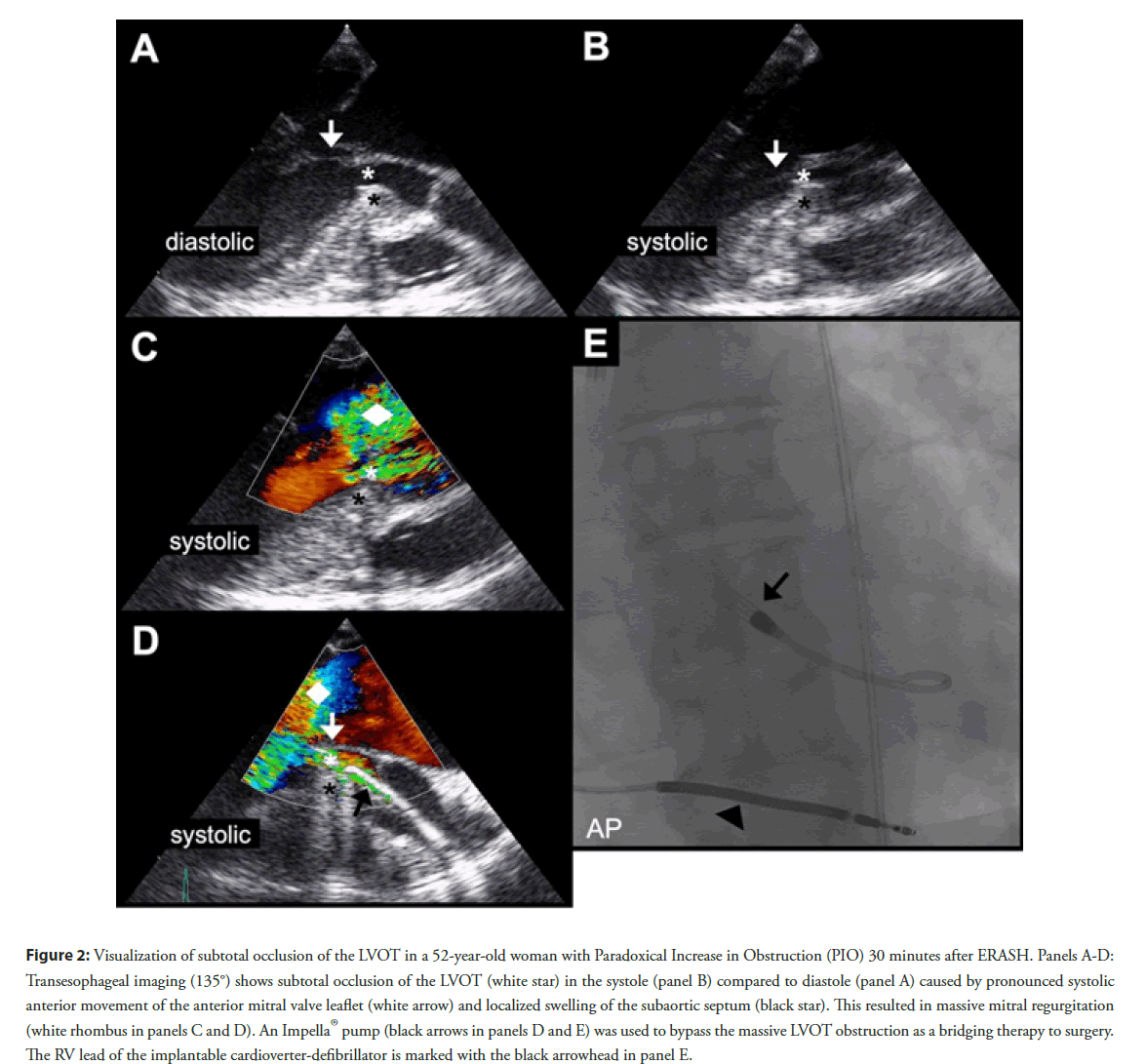 interventional-cardiology-paradoxical