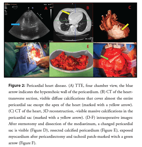 interventional-cardiology-pericardiectomy