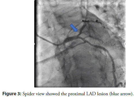 interventional-cardiology-proximal