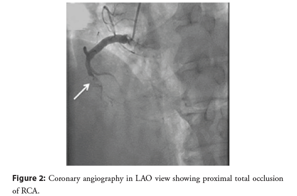 interventional-cardiology-proximal