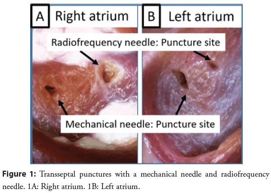 interventional-cardiology-radiofrequency