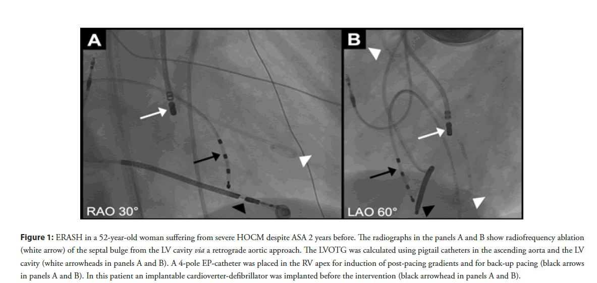 interventional-cardiology-radiofrequency
