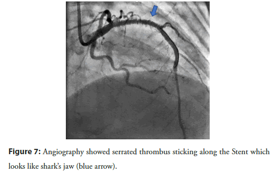 interventional-cardiology-serrated