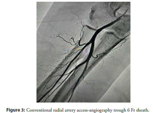 interventional-cardiology-sheath