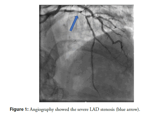 interventional-cardiology-stenosis