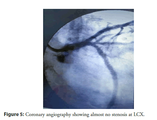 interventional-cardiology-stenosis